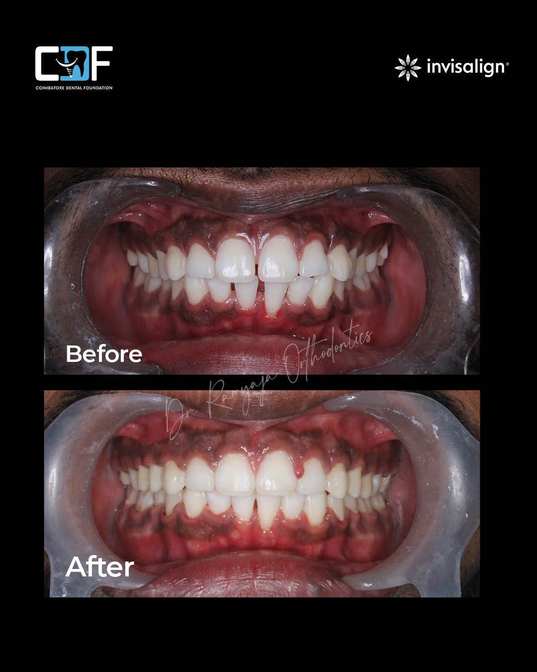 Before After Result